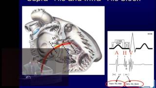 서맥부정맥 2 오용석교수 Bradycardia 2 Prof YS Oh [upl. by Tarr52]