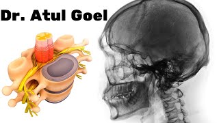 Craniovertebral junction surgeryDr Atul Goel [upl. by Arracot882]