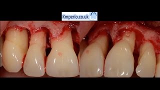 Periodontal Surgery with Regeneration for Upper Teeth [upl. by Llebana459]