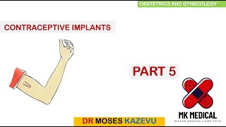 Subdermal implant contraceptives  Part 5 [upl. by Afra97]