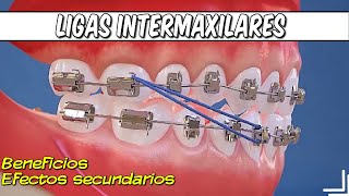 Elásticos Intermaxilares ¿Qué son ¿Para qué Sirven  Beneficios de las Ligas Intermaxilares [upl. by Acinad]