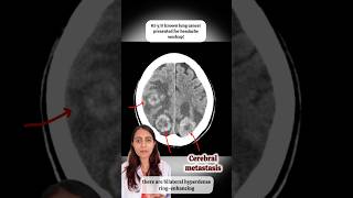 Cerebral metastasis brain cerebral metastasis cancer cáncer neet usmle neetpg medicine [upl. by Saihttam]