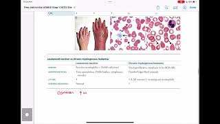 leukemoid reaction vs cml haematology 89 First Aid USMLE Step 1 in UrduHindi [upl. by Ihn]