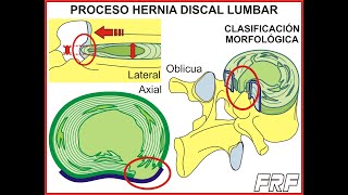 Proceso y clasificación de la hernia discal lumbar [upl. by Torry]