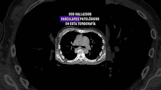 Patología vascular de torax por tomografia 🔍🤓 radiology medicine [upl. by Adneral]