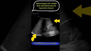 Splenomegaly with multiple fairly well defined discrete hypoechoic lessons ultrasound shorts [upl. by Minta229]