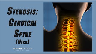 Cervical Spine Stenosis  Best Exercises to Decrease Pain and Other Symptoms [upl. by Ahtnamys]