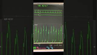 Right Heart Catheterization study with swan ganz catheter [upl. by Enyawad]