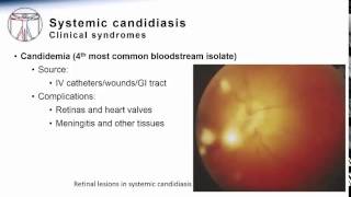 Candida Systemic Candidiasis [upl. by Ahsille402]