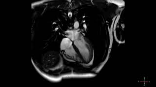 How to identify normal heart structures on a cardiac CT scan [upl. by Hester]