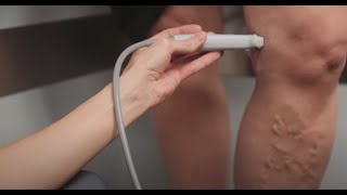 Varicose Vein Treatment amp EVLT Video by Dr Janna Bentley  Lakeshore Vein amp Aesthetics Clinic [upl. by Kcirdnekel557]