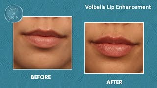 Volbella lip enhancement to vermillion border [upl. by Kristos]