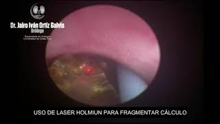 LITOTRICIA LASER EN CALCULO URETERAL DERECHO [upl. by Fionnula5]