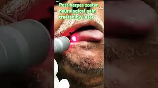 Herpes zoster treated by Laser [upl. by Ailicec363]