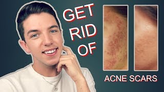 How to Get Rid Rid of Acne Scars Completely [upl. by Llert839]