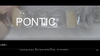 Pontic  facette dentaire en orthodontie par Aligneur et Invisalign [upl. by Einaj]