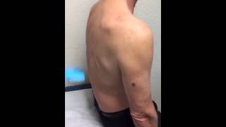 Shoulder Steroid Injection by Dr Gawayne Vaughan  Auburn Medical Group [upl. by Stricklan]