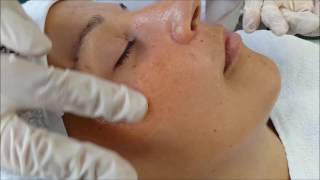 Yellow Peel Treatment [upl. by Gavette]