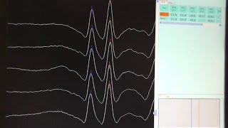 Neuromuscular junction tests Repetitive Nerve Stimulation and Single Fibre EMG [upl. by Pulchia]