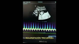 HIDROPS FETAL hidrops fetal embarazo santamarta barranquilla hijos perinatologo materno [upl. by Imoin]