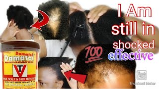 how to massage your scalp with damatol 4 thicker amp longer hair growthregrow baldspot amp edges fast [upl. by Yelkrab]