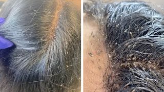 Hair Clinic Remove Hundreds Of Lice From Clients Head [upl. by Harwill]