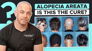 New Drug Olumiant Baracitinib Approved for Alopecia Areata [upl. by Salchunas]