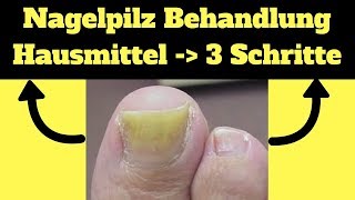 Nagelpilz Behandlung Hausmittel ✔ 3 Schritte um ekligen Nagelpilz loszuwerden [upl. by Emlyn]