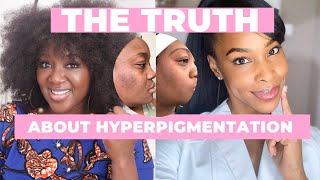 The TRUTH about Hyperpigmentation and Black Skin [upl. by Saffier]