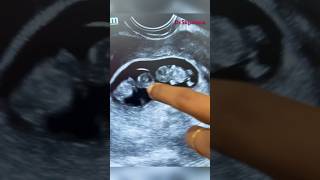 Early pregnancy scan  pregnancy confirmation  twin pregnancy  gynaecologist doctorsvlogs [upl. by Stroud]