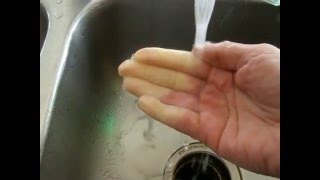 Raynauds Phenomenon in real time [upl. by Arrehs953]