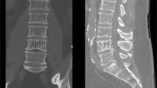 Spine lecture hemangioma of spine [upl. by Scales]