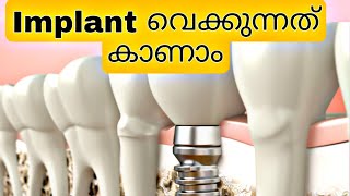 Implant വെക്കുന്നത് കാണാം  dental implant malayalam  dental implant  implant veppu pallu [upl. by Helga245]