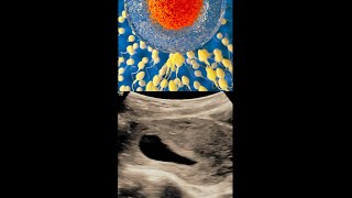 Anembryonic Pregnancy  Blighted Ovum   Pregnancy with Empty Gestational Sac ultrasound [upl. by Anal192]