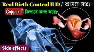 How IUD Works to Prevent Pregnancy Animation। Copper T Insertion and Side Effects । [upl. by Oironoh]