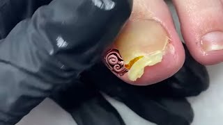 TRIMMING fungal Toenail with onycholysis [upl. by Enyamart]