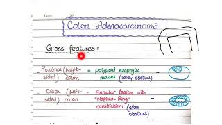 Colon Adenocarcinoma  Morphology [upl. by Isleen500]