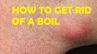 how to get rid of boils under the armpit step by step at home [upl. by Wolsniw718]