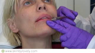 Lip Injection Treatment Video with Before and After Photo [upl. by Andrew]