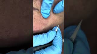 Watch Electrolysis Hair Removal in Action [upl. by Ynamreg]