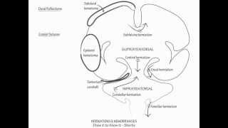 Herniation amp Intracranial Hemorrhage  Draw it to Know it Neuroanatomy [upl. by Aglo799]