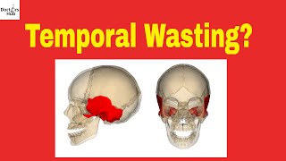 Cancer Wasting  Temporal Wasting  Wasting Syndrome  Malignant Cachexia [upl. by Carlina629]