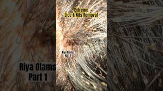 How to treat lice on hairlice treatment in Chennailice treatment in parlourlice removallice [upl. by Jahdal]