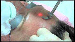 Sciton  ProFractional Therapy [upl. by Reinert]