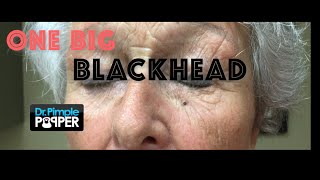 One big blackhead just for Cliffo in Queensland AU Listen to HOTFM Townsville [upl. by Hammond666]