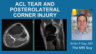 ACL TEAR WITH POSTEROLATERAL CORNER INJURY [upl. by Stoller635]