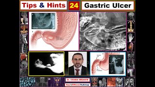 Benign vs malignant gastric ulcers Tips amp Hints 24 Hamptons sign vs carman meniscus sign [upl. by Burris]