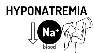 HYPONATREMIA made easy [upl. by Rieger]