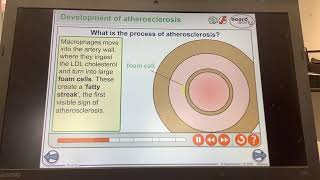 KS4GCSEBIOLOGYOrganisationThe process of atherosclerosis [upl. by Nebeur]