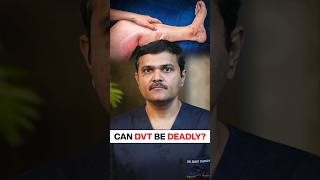 Can leg swelling be FATAL bloodclot shortvideo [upl. by Anawal]